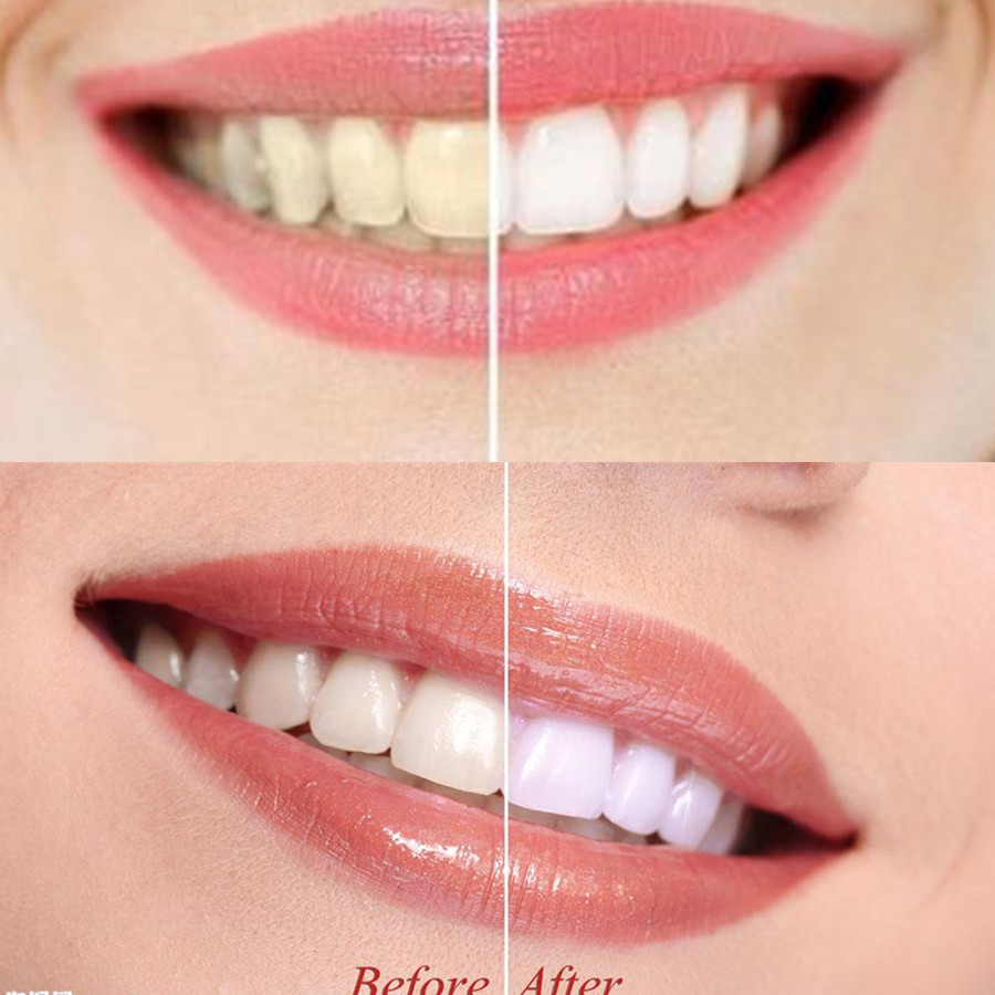Than Tre Răng Răng Nha Khoa De - đánh giá và giá Teeth Whitening Charcoal