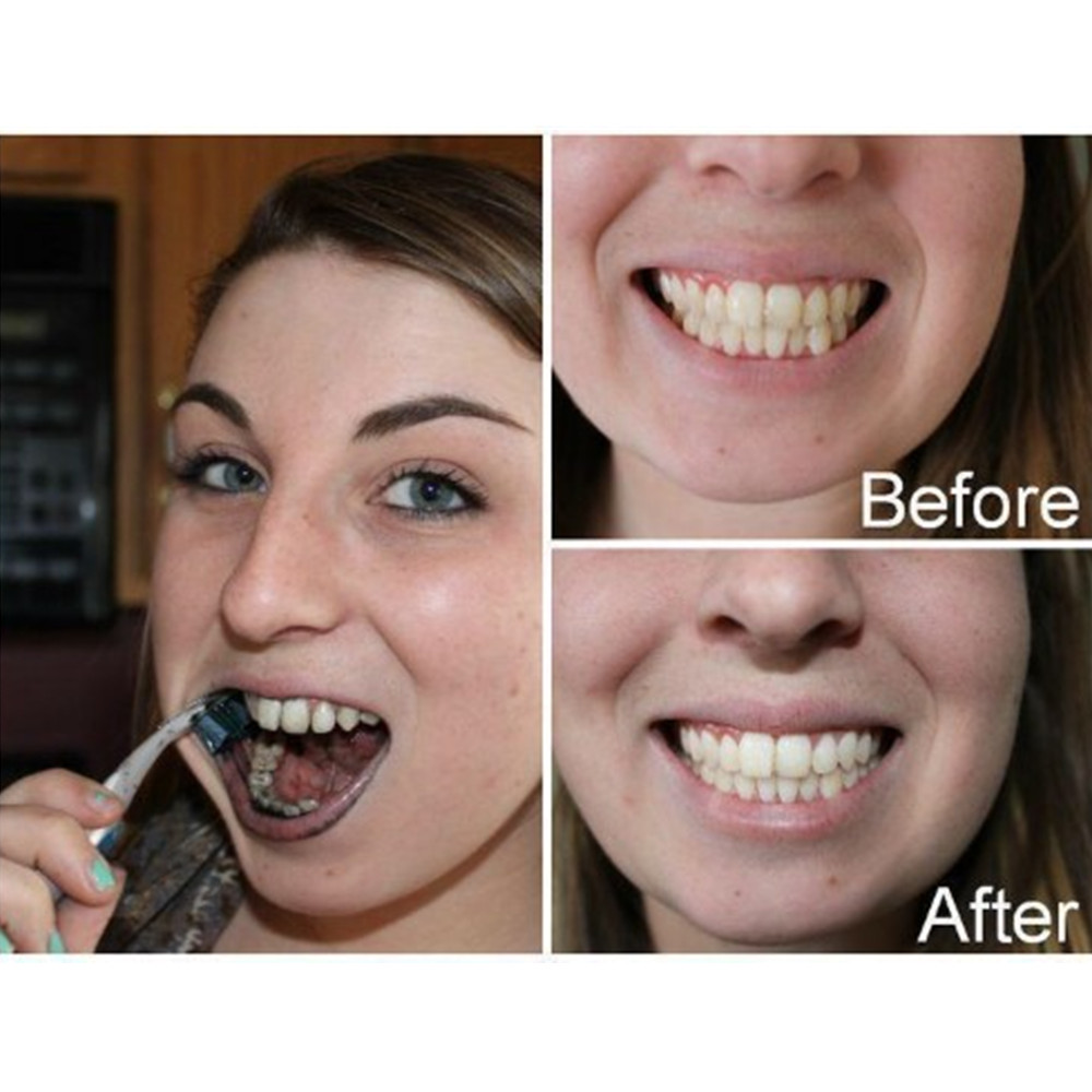 Than Tre Răng Răng Nha Khoa De - đánh giá và giá Teeth Whitening Charcoal