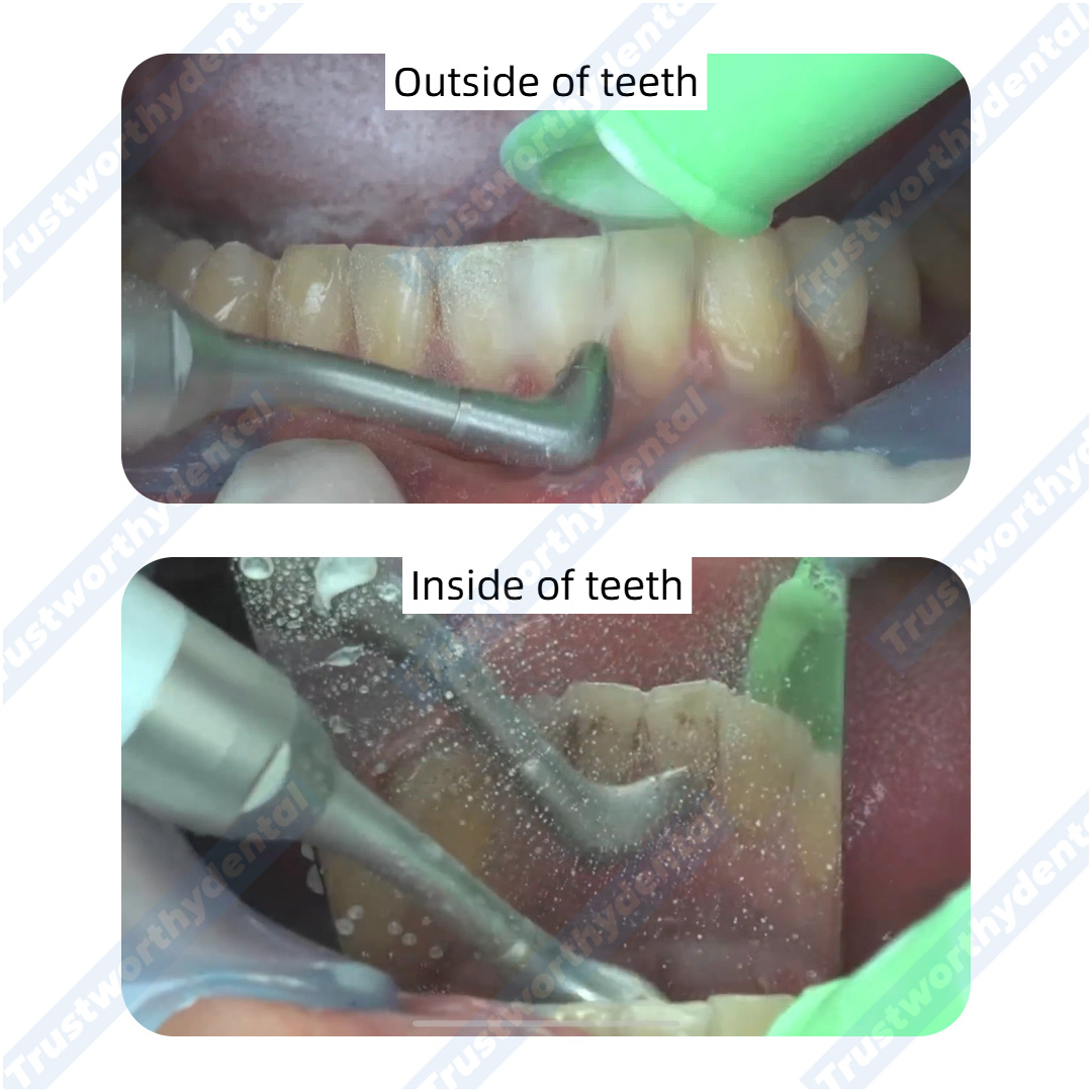 Dental Air Polisher Oral Autoc - đánh giá và giá Colgate Whitening Teeth